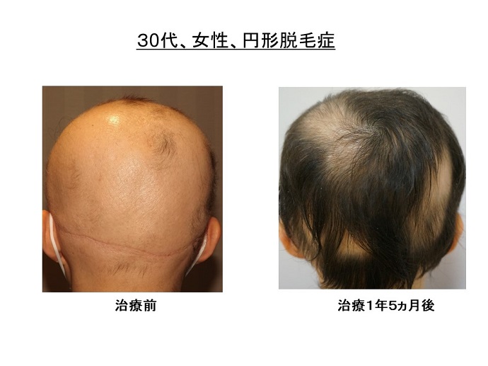 円形脱毛症　病院